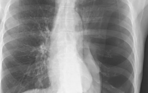 Picture of chest x-ray