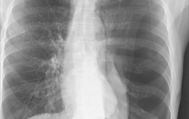 Chest X-ray showing collapsed lung, or pneumothorax. Image courtesy of Rachael Callcut, MD.