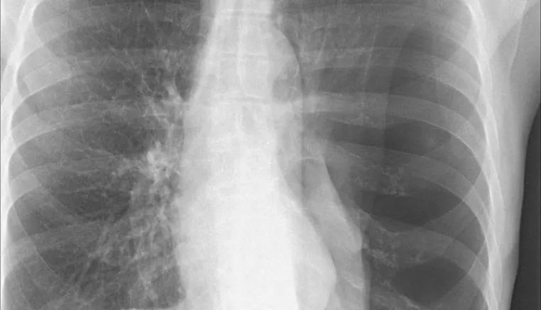 Chest X-ray showing collapsed lung, or pneumothorax. Image courtesy of Rachael Callcut, MD.